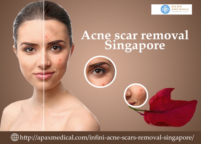 Acne scar removal Singapore
